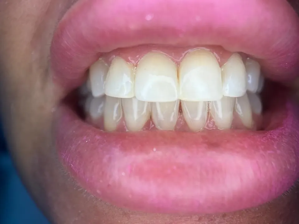 Teeth straightening after treatment at MandarinDent Bodrum