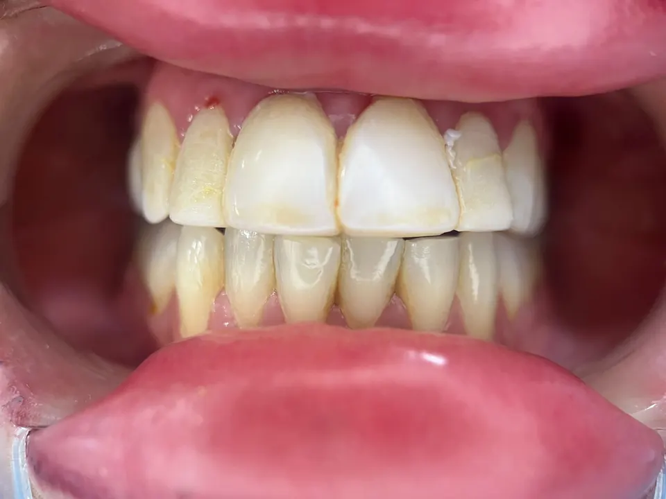 Teeth whitening before treatment at MandarinDent Bodrum