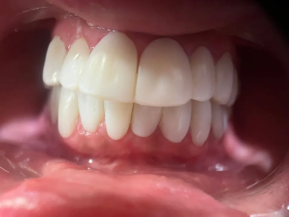 Teeth whitening after treatment at MandarinDent Bodrum
