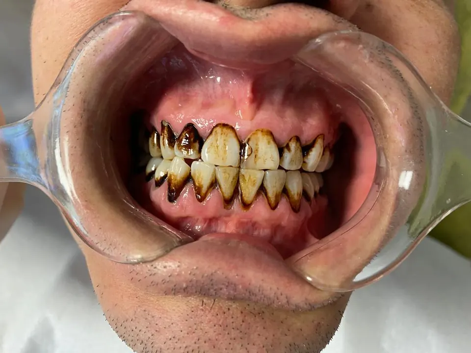 Zirconium crowns before treatment at MandarinDent Bodrum