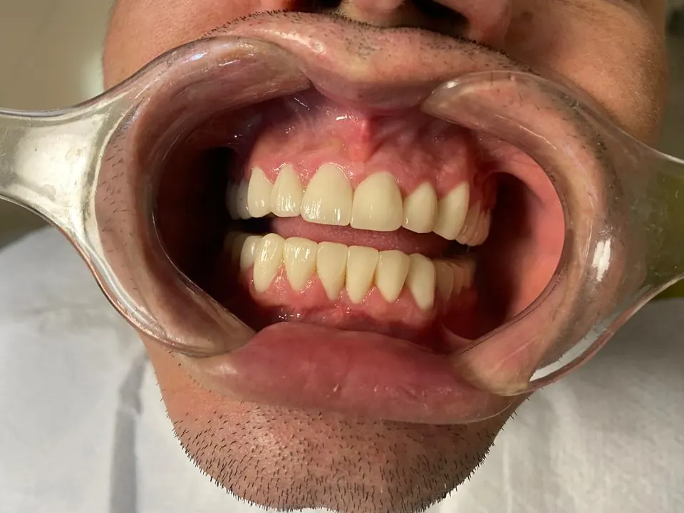 Zirconium crowns after treatment at MandarinDent Bodrum
