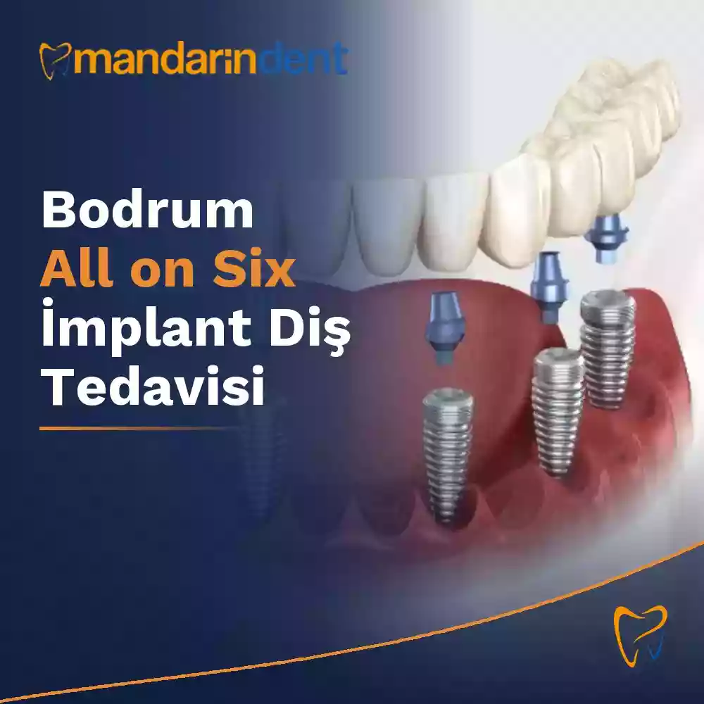 Bodrum All on Six İmplant Diş Tedavisi – Tam çene sabit protez için altı implantla yapılan kişiye özel planlama