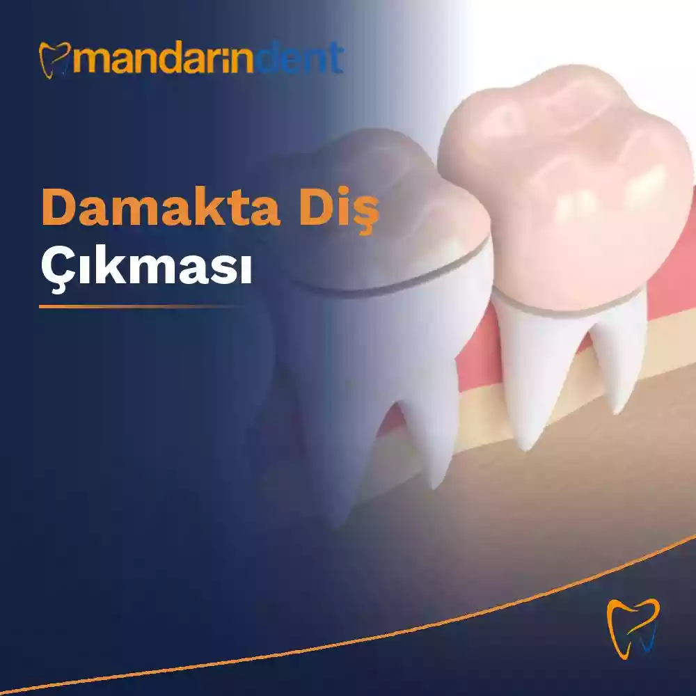 Damakta Diş Çıkması – Damak tarafında konumlanan bir dişin değerlendirilmesinde muayene ve görüntülemenin önemi