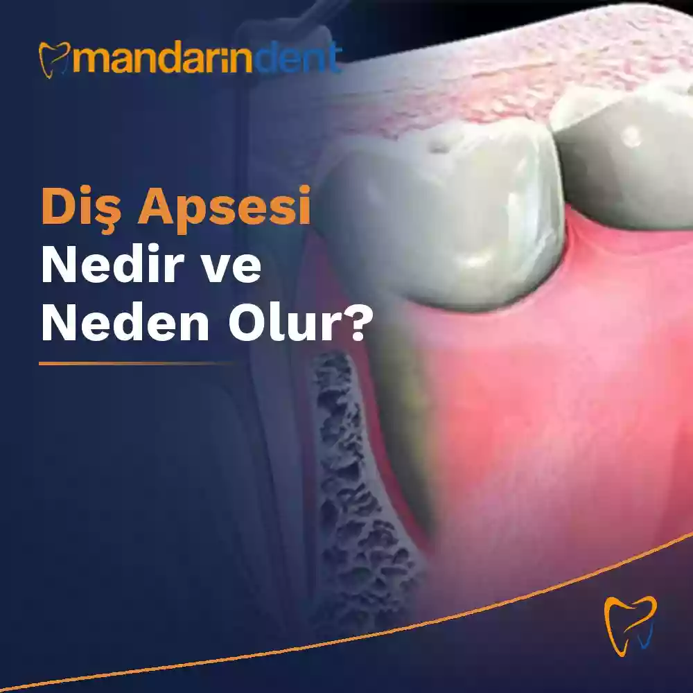 Diş Apsesi Nedir ve Neden Olur?