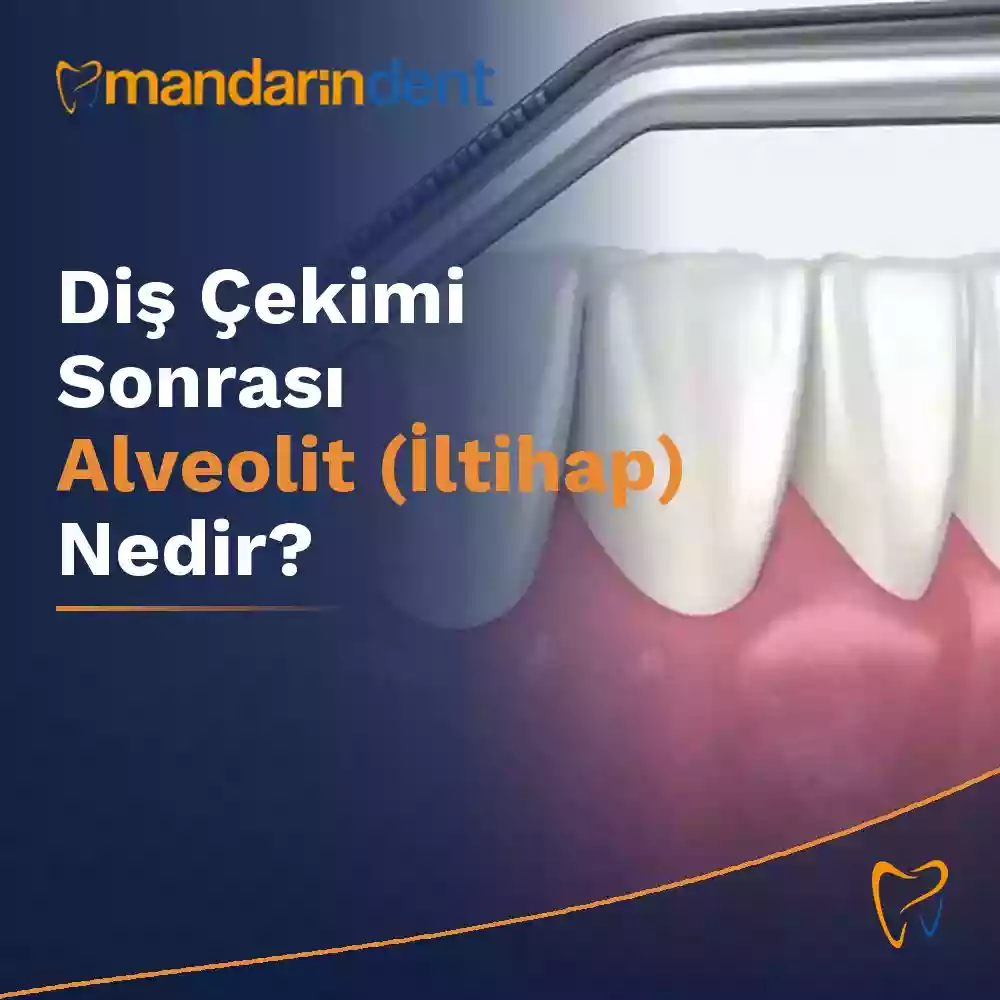 Alveolit ve diş çekimi sonrası evde bakım bilgilendirme görseli