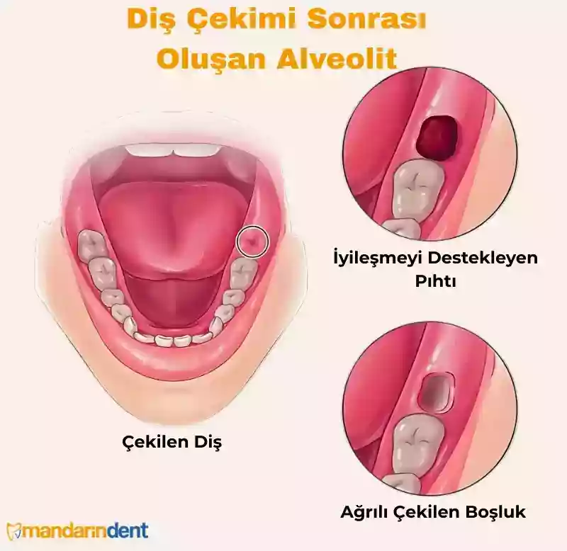 Diş çekimi sonrası alveolit örnek görünümü