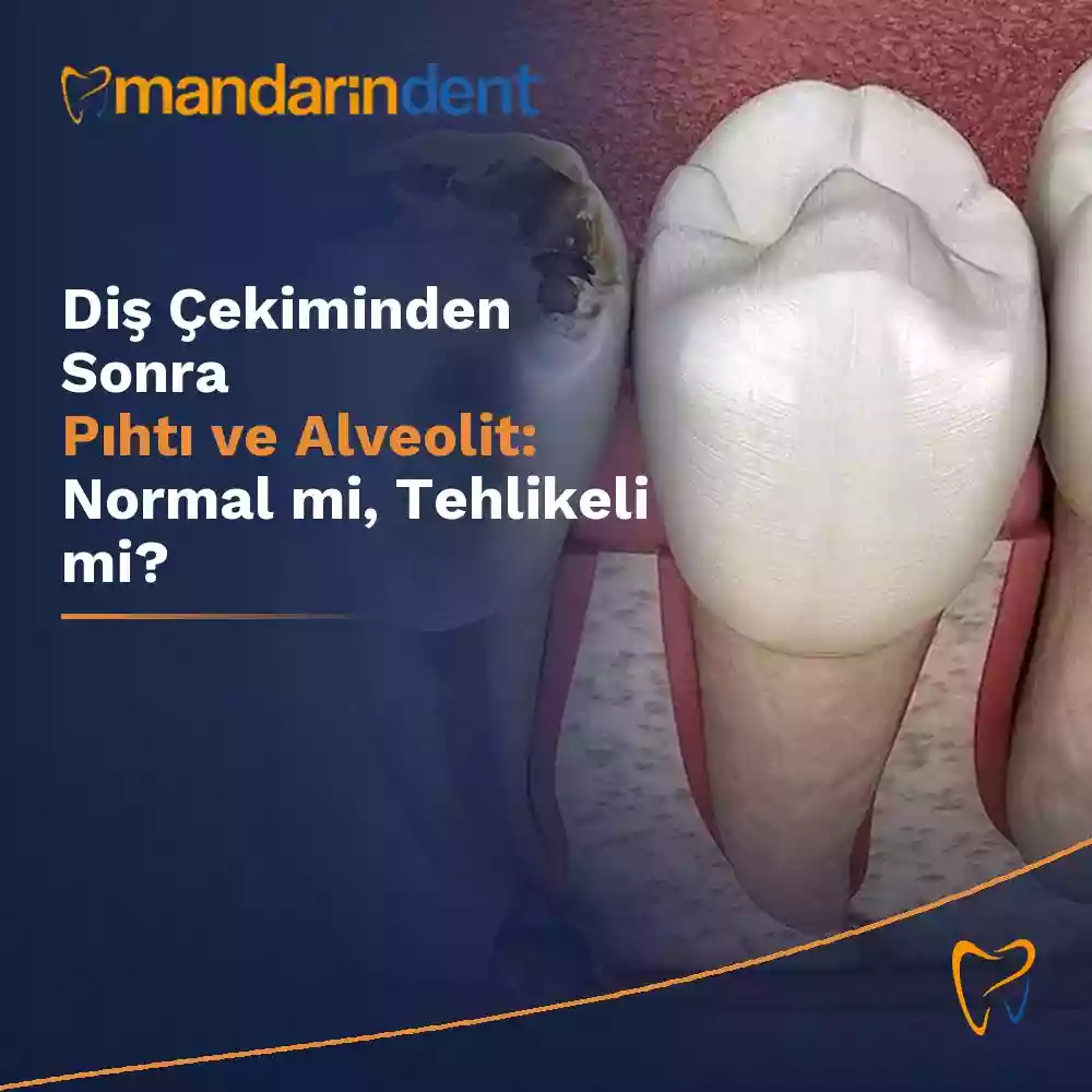 Diş çekiminden sonra pıhtı ve alveolit – çekim boşluğunda iyileşme