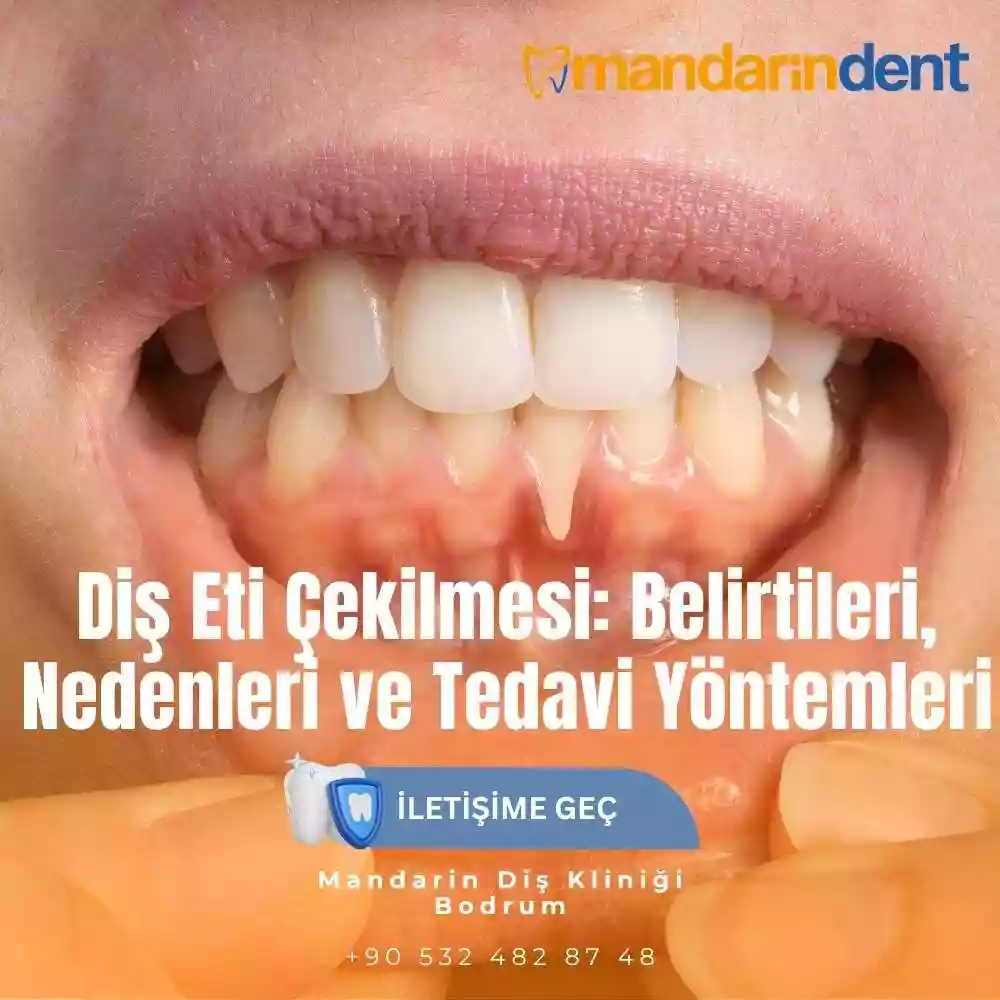 Diş Eti Çekilmesi: Belirtileri, Nedenleri ve Tedavi Yöntemleri
