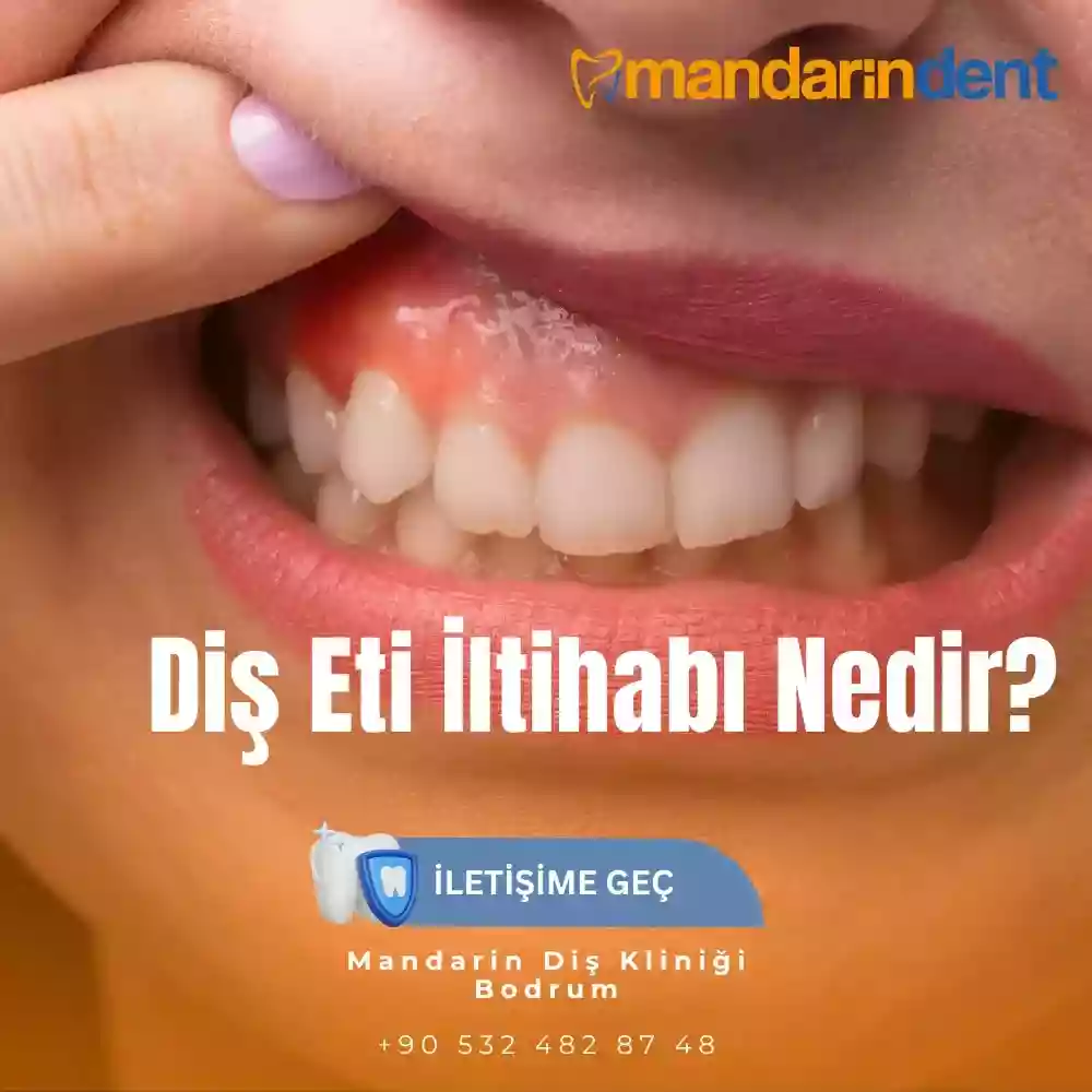 Diş Eti İltihabı Nedir – diş eti iltihabı ve belirtileri