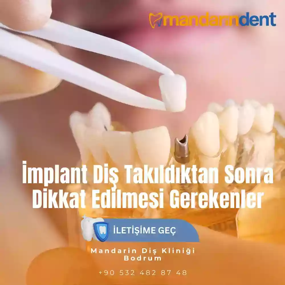Diş implantı sonrası ağrı – geçmeyen implant ağrısı