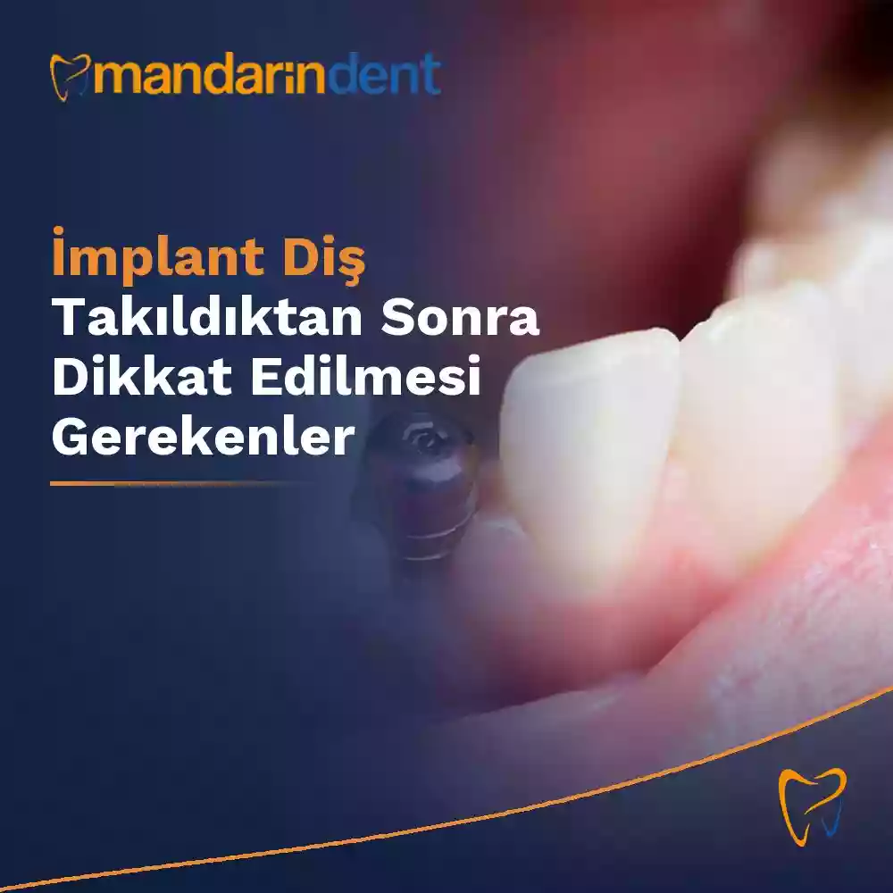 İmplant diş takıldıktan sonra dikkat edilmesi gerekenler – implant sonrası bakım