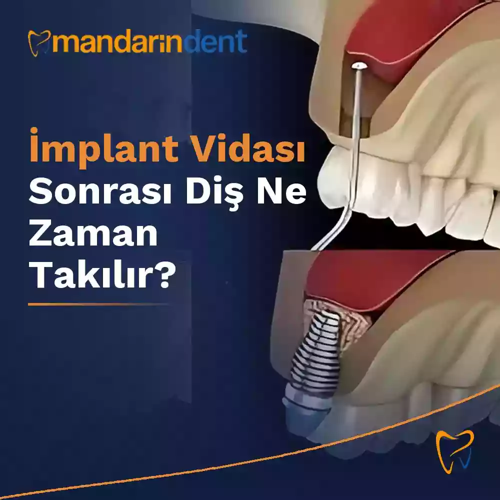 İmplant Vidası Sonrası Diş Ne Zaman Takılır?