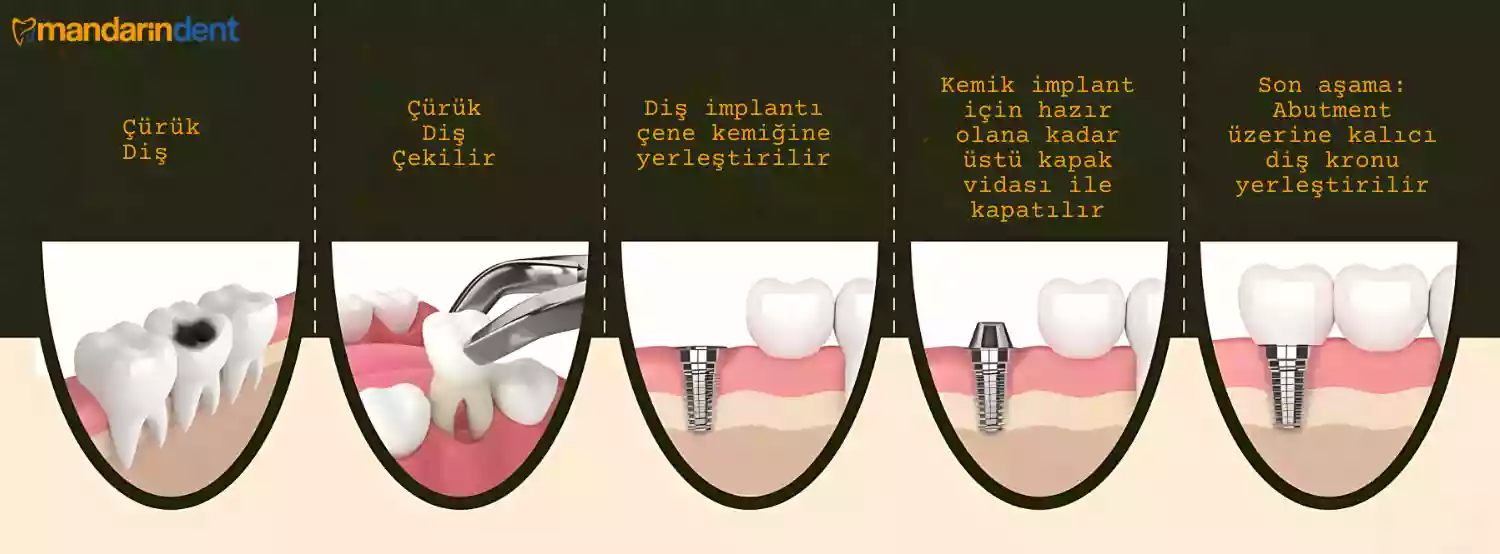 İmplant vidası sonrası diş ne zaman takılır – implant aşamaları