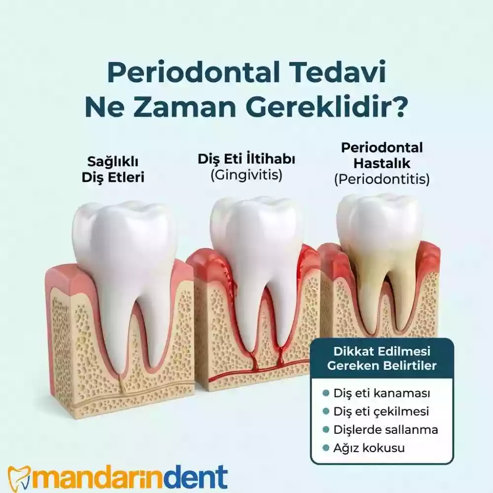 Periodontal Tedavi Nedir, Kimlere Uygulanır?