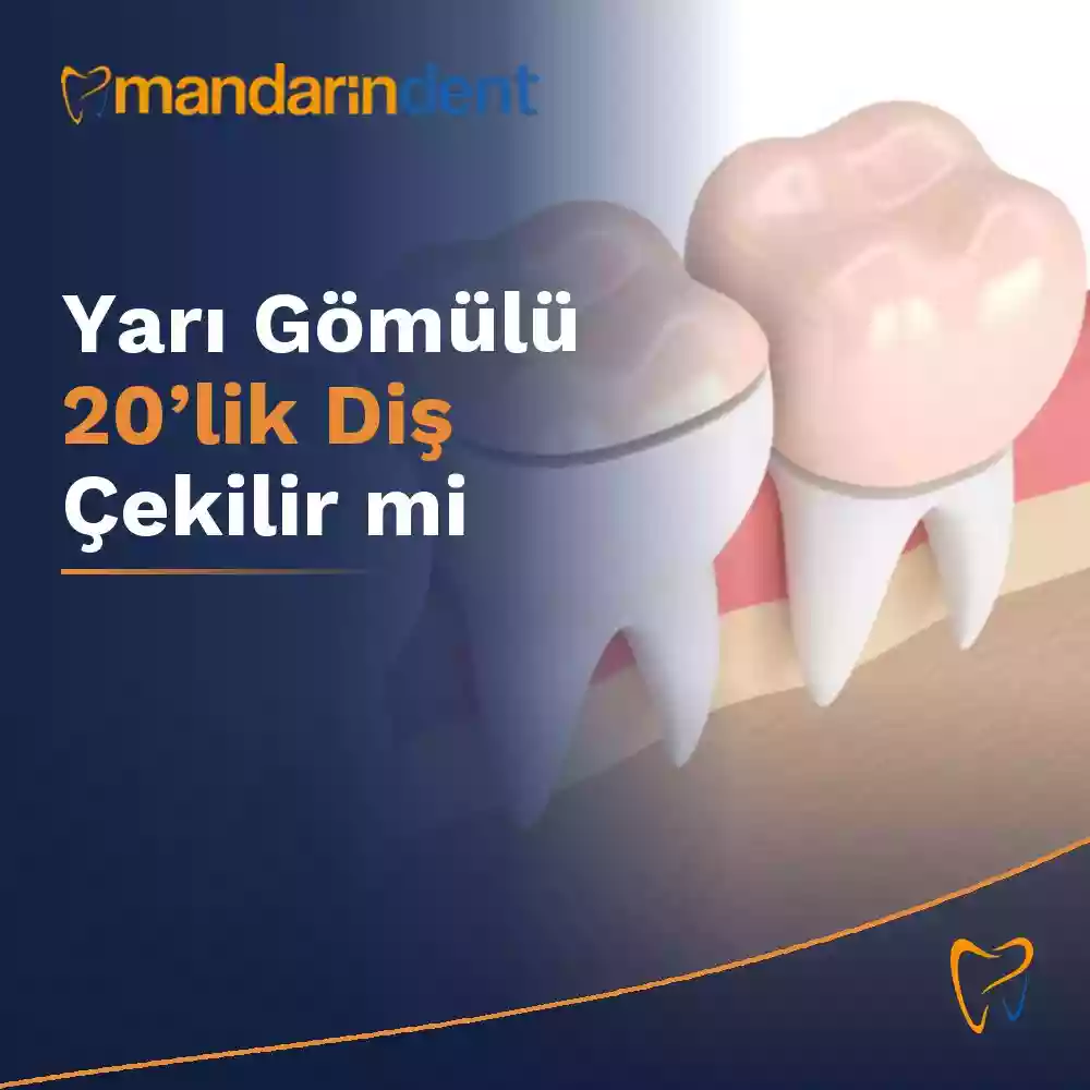 Yarı gömülü 20’lik diş çekilir mi? Muayene ve tedavi seçenekleri